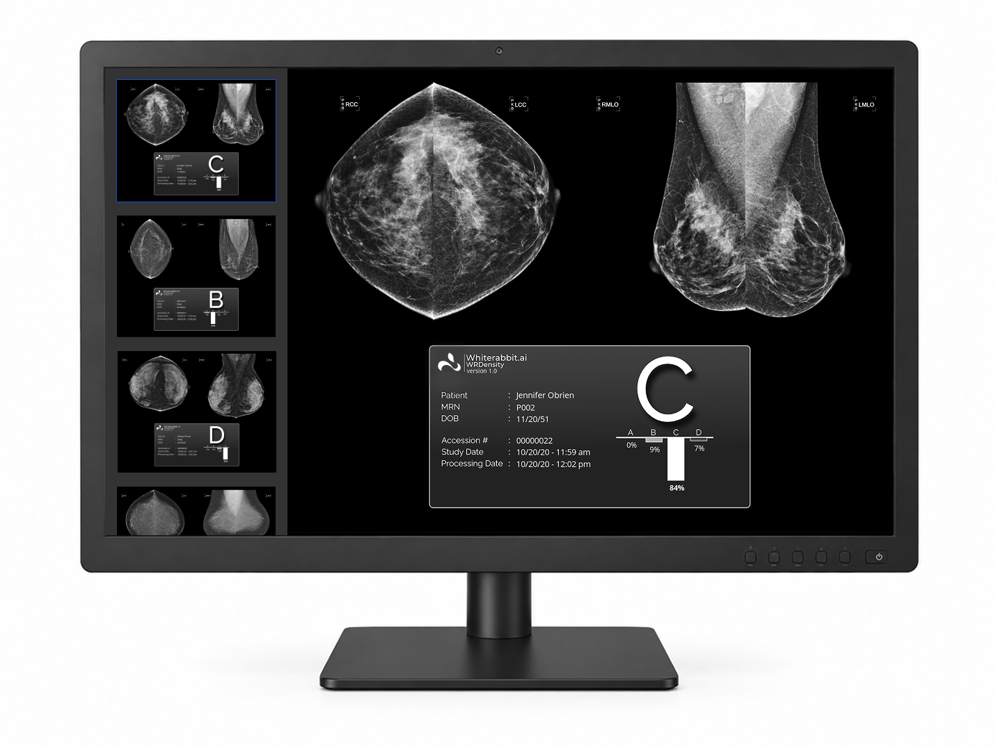 Software WRDensity de Whiterabbit.ai evaluando densidad mamaria